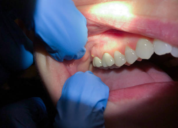 Best Root Canal Emergency Dentist  in Walkersville, MD